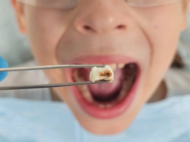 Best Emergency Broken Tooth Repair in Senoia, GA
